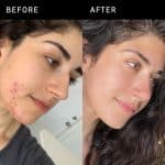 Inkey list succinic acid acne treatment - Image 2